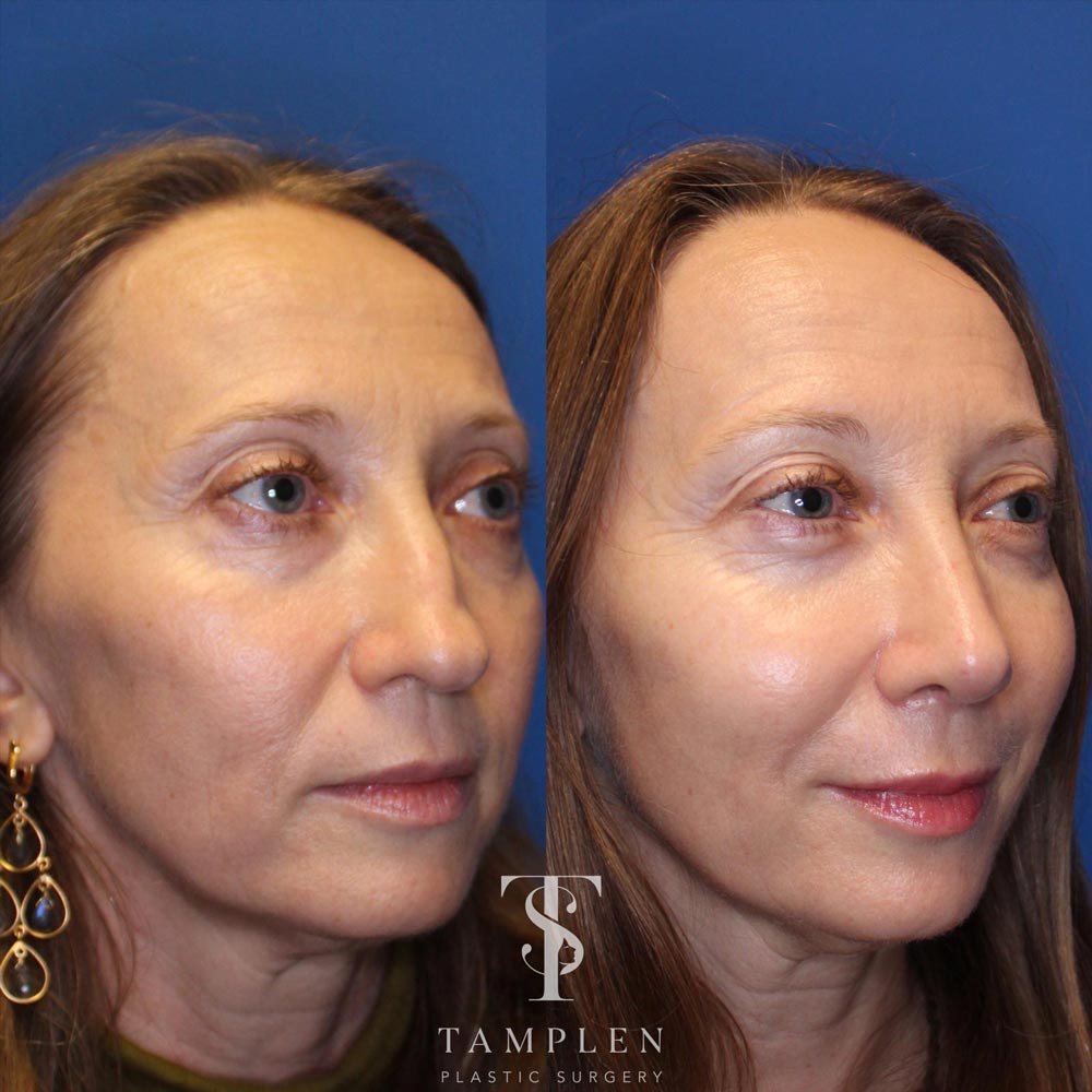 Patient had prior “functional” nasal surgery including septoplasty by another surgeon who left here unhappy with her cosmetic result. I performed my standard rhinoplasty approach to improve both form and function. She is now breathing great and loves her nasal appearance.