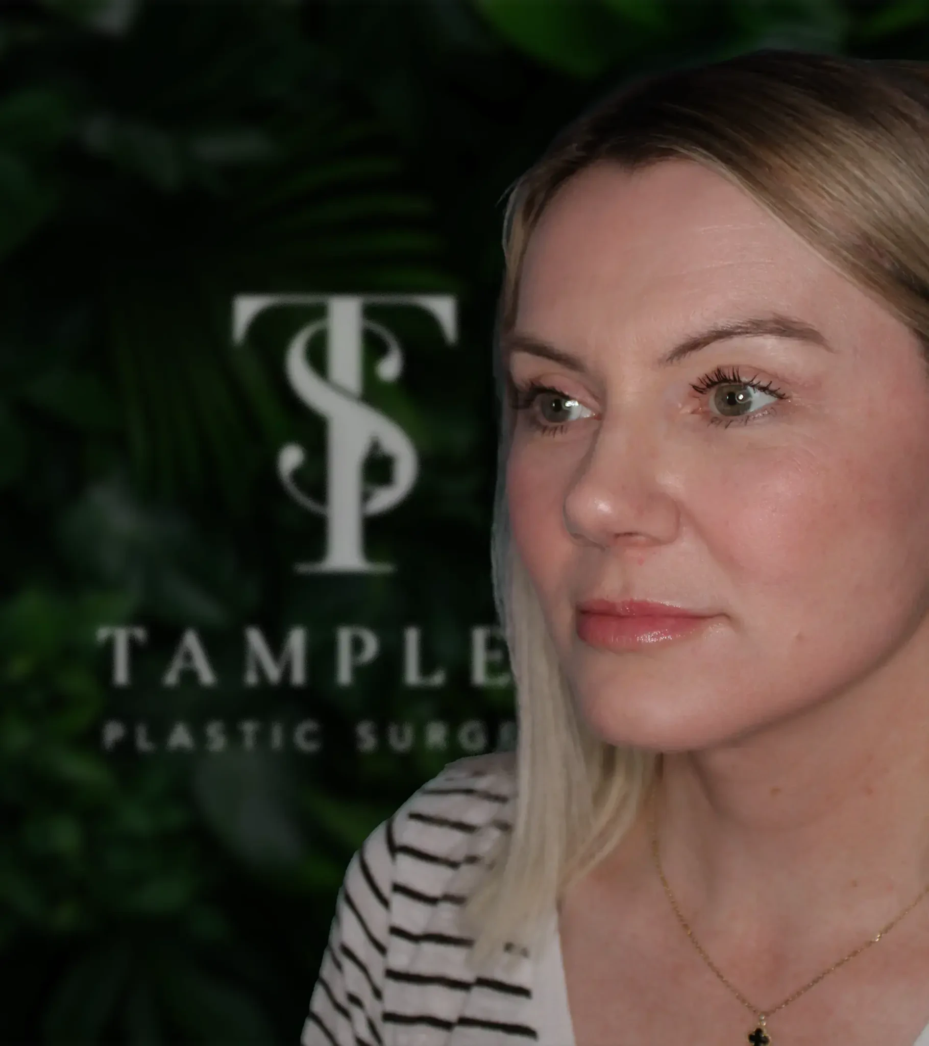 Female patient blepharoplasty eyelid surgery results at Tamplen Plastic Surgery