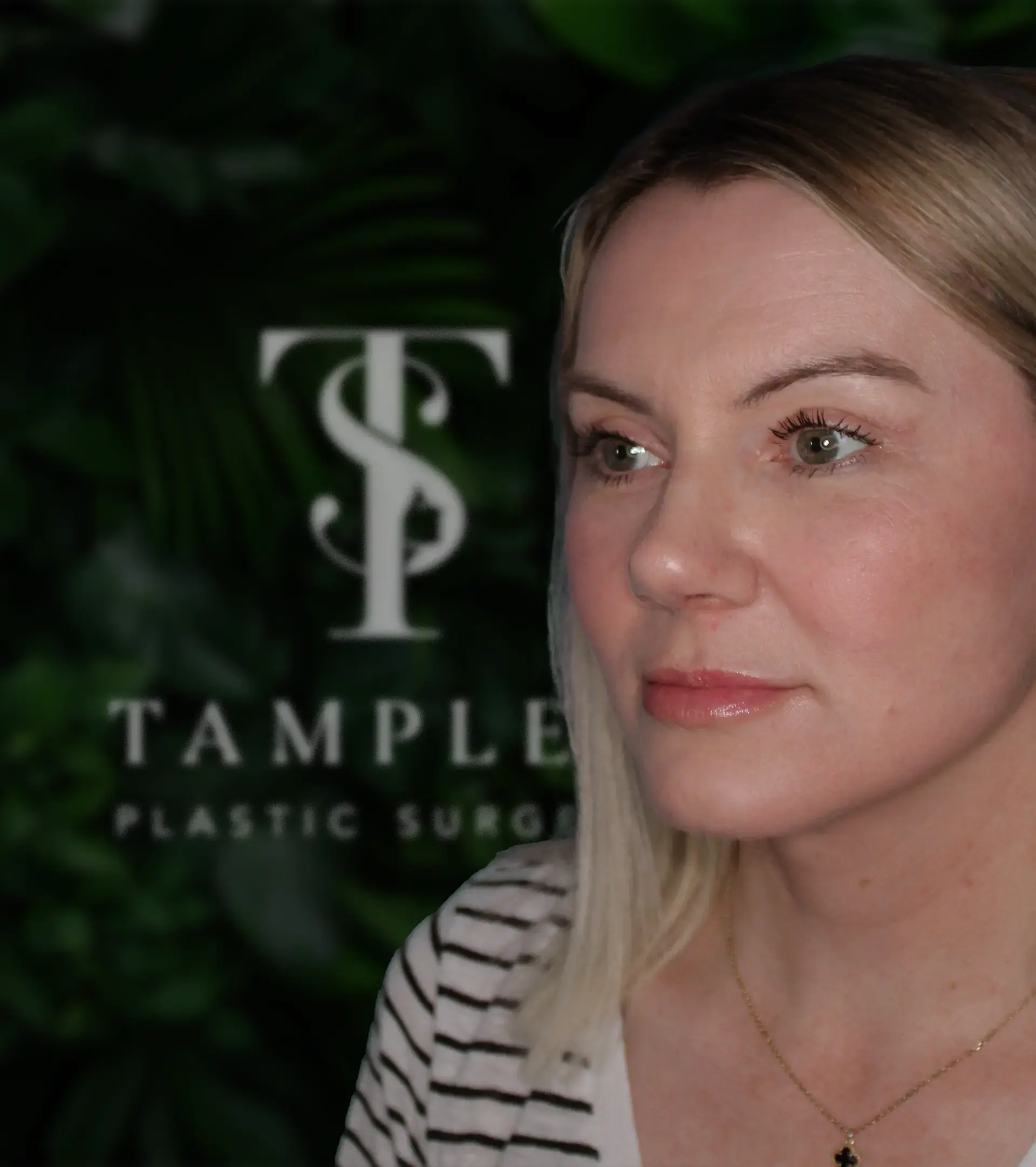 Female patient mini facelift results at Tamplen Plastic Surgery Orinda location